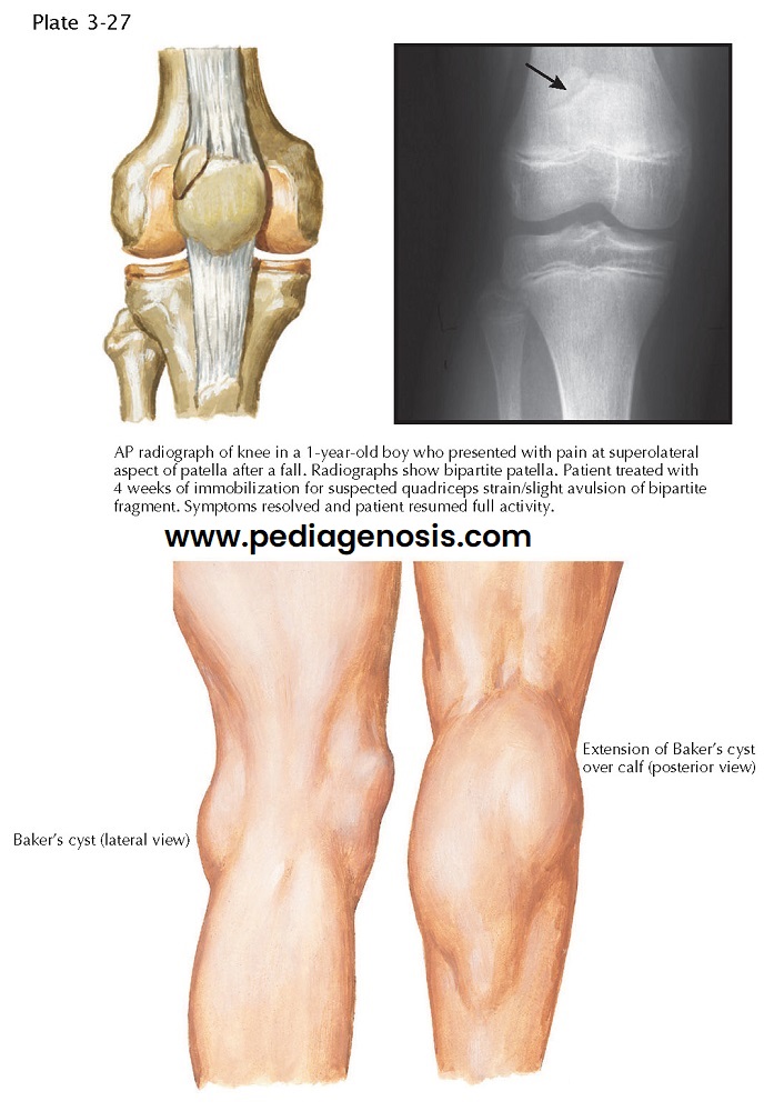 BIPARTITE PATELLA AND BAKER’S CYST