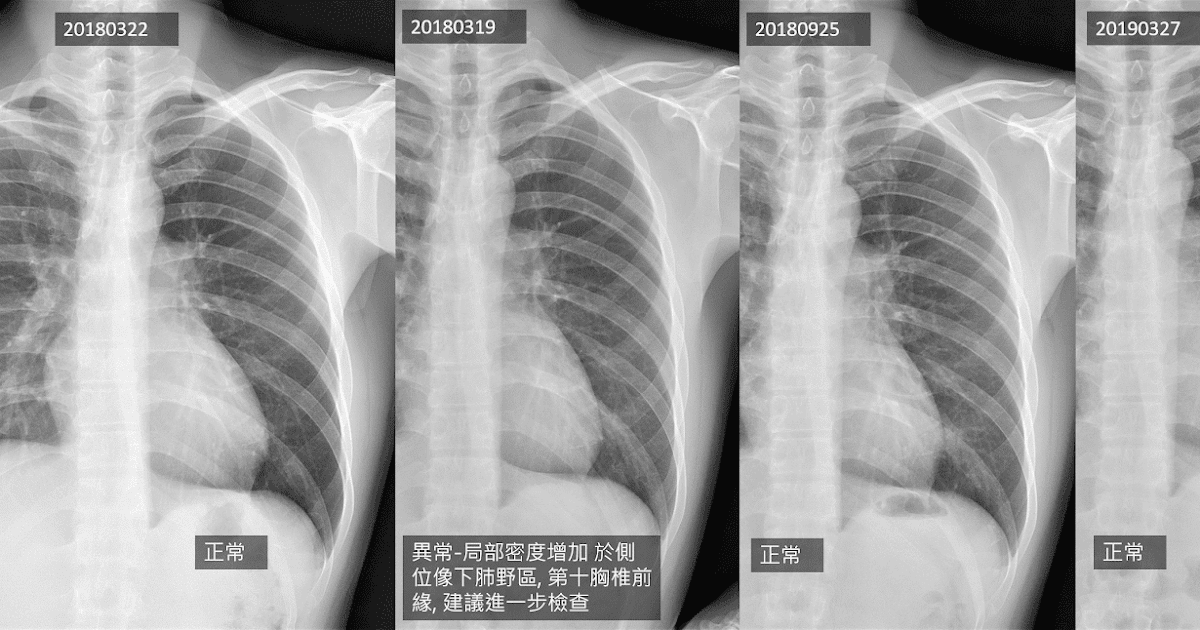 [經驗] 肺20mm實心結節放射狀血管增生