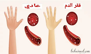 فقر الدم أعراض من 15 من