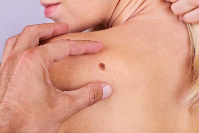 Melanoma is one of the most severe forms of skin cancer. It's the cancer of the skin that can have some very dire consequences, including the fact that it's possible to have melanoma be malignant.