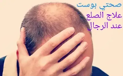 علاج الصلع عند الرجال : أسباب الصلع و طرق علاجه