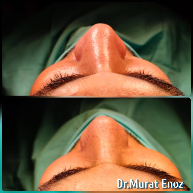 Natural nose aesthetic surgery for male,Male thick skinned rhinoplasty,Ethnic expert rhinoplasty surgeon,Ethnic Rhinoplasty in Istanbul,