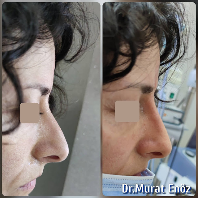 5 Minutes Nose Job With Filler in Istanbul, Non surgical liquid rhinoplasty