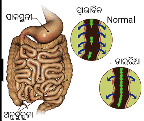 ଡାଇରିଆ (Diarrhoea) - ରୋଗର କାରଣ ଓ ନିଦାନ | DIARRHEA CAUSES TREATMENT AND SYMPTOMS IN ODIA