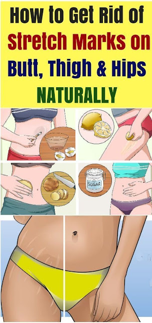 How To Get Rid Of Stretch Marks On Hips
