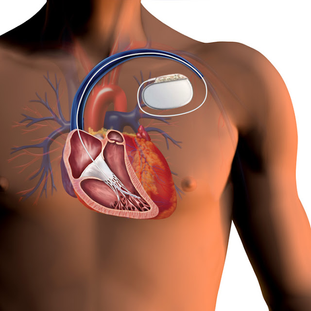 Cardiac Pacing Leads