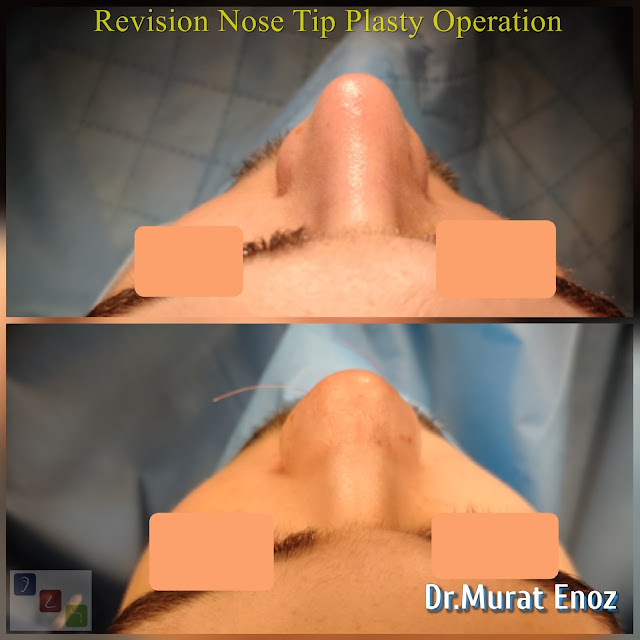 Revision Aesthetic Nose Tip Surgery,Revision Nose Tip Plasty in Istanbul,