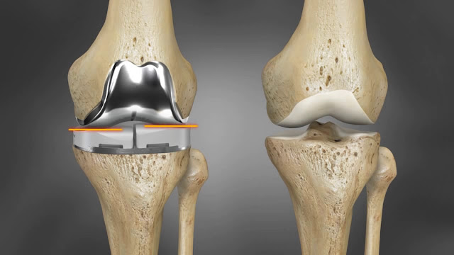 Knee Implants Market