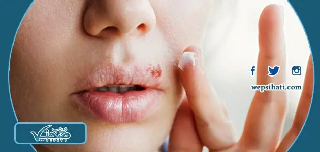 كيفية علاج الهربس الفموي في المنزل لدى الأطفال
