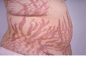 Rapid weight loss is a common cause of stretch marks