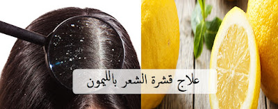 4 طرق بسيطة  لعلاج قشرة الشعر بالليمون