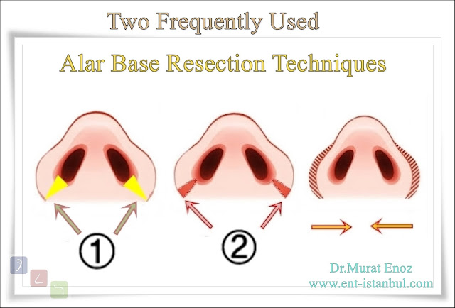 Two Frequently Used Alar Base Resection Techniques  ((Apart From These Incisions, There Are Also Modified Techniques and Different Alar Base Resection Techniques!))