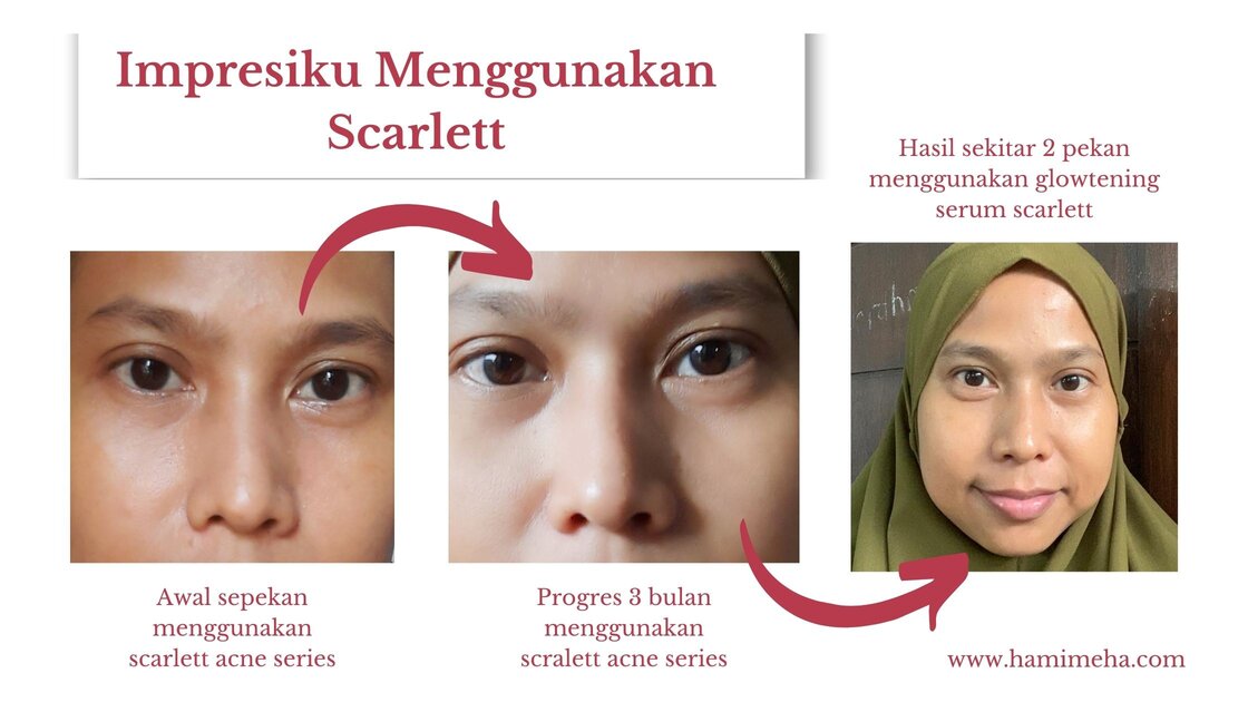 Hasil menggunakan face care scarlett acne series dan glowteninng serum scarlett