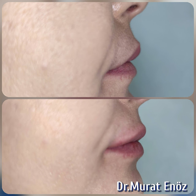 Lip Filler Injection - Augmentation in Istanbul