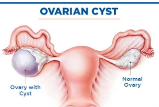 Kya Ovarian Cyst ki wajah se dard hota hai? - क्या ओवेरियन सिस्ट के कारण दर्द हो सकता है_ichhori.com