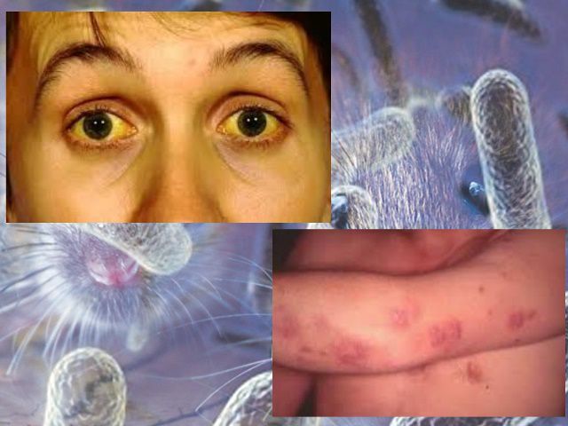Um dos sintomas da Leptospirose é os olhos amarelado e pele com erupções