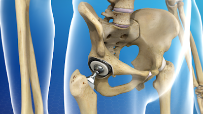 Hip replacement implants Market