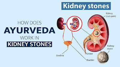 Ayurveda works in Kidney Stones