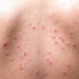 How Do I Get Rid Of Pimples On My Back And Shoulders?