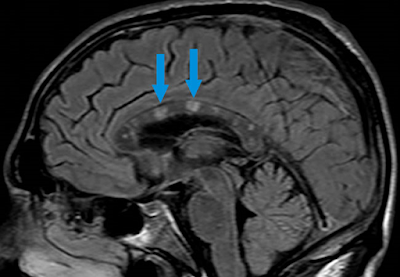 Consult QD - Cleveland Clinic Elucidating the Pathophysiology of Susac Syndrome – Co