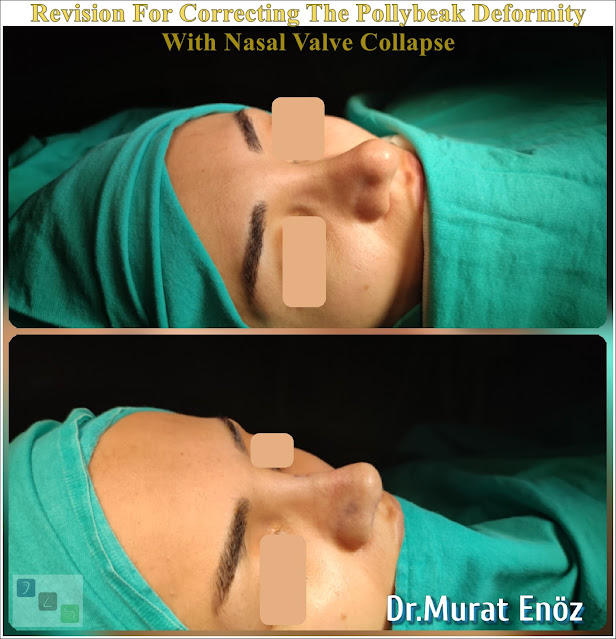 Nasal valve collapse, Pollybeak Deformity, Polly Beak Nose Deformity,