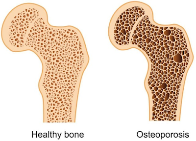 Penyebab Dan Cara Mengatasi Penyakit Tulang Keropos