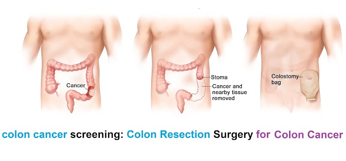 colon cancer screening: Colon Resection Surgery for Colon Cancer