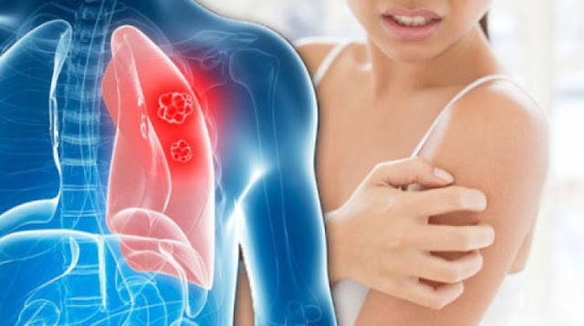 Stručnjak je opisao kožne simptome raka pluća