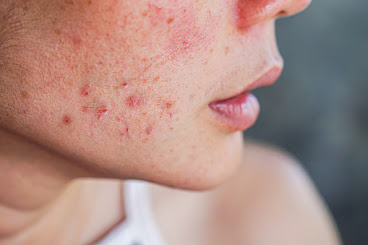 Acne Specialist doctor near me