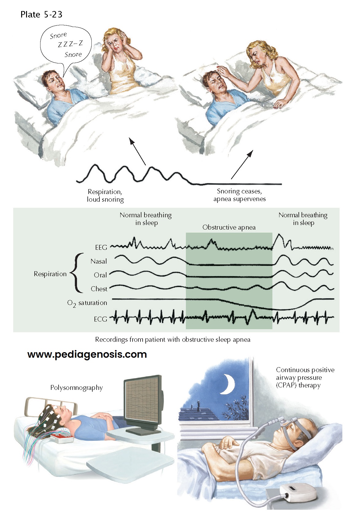 Sleep-Disordered Breathing