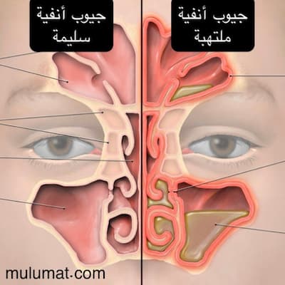 التهاب الجيوب الأنفية، صداع الجيوب الأنفية، أعراض الجيوب الأنفية الحادة، أعراض التهاب الجيوب الأنفية المزمن