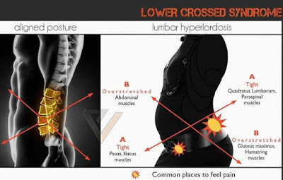 Lower-Crossed Syndrome, Back pain, Hip pain, SI joint Pain, Physiotherapy, Psoas Muscle, Back Extensors Muscle, Muscle Weakness