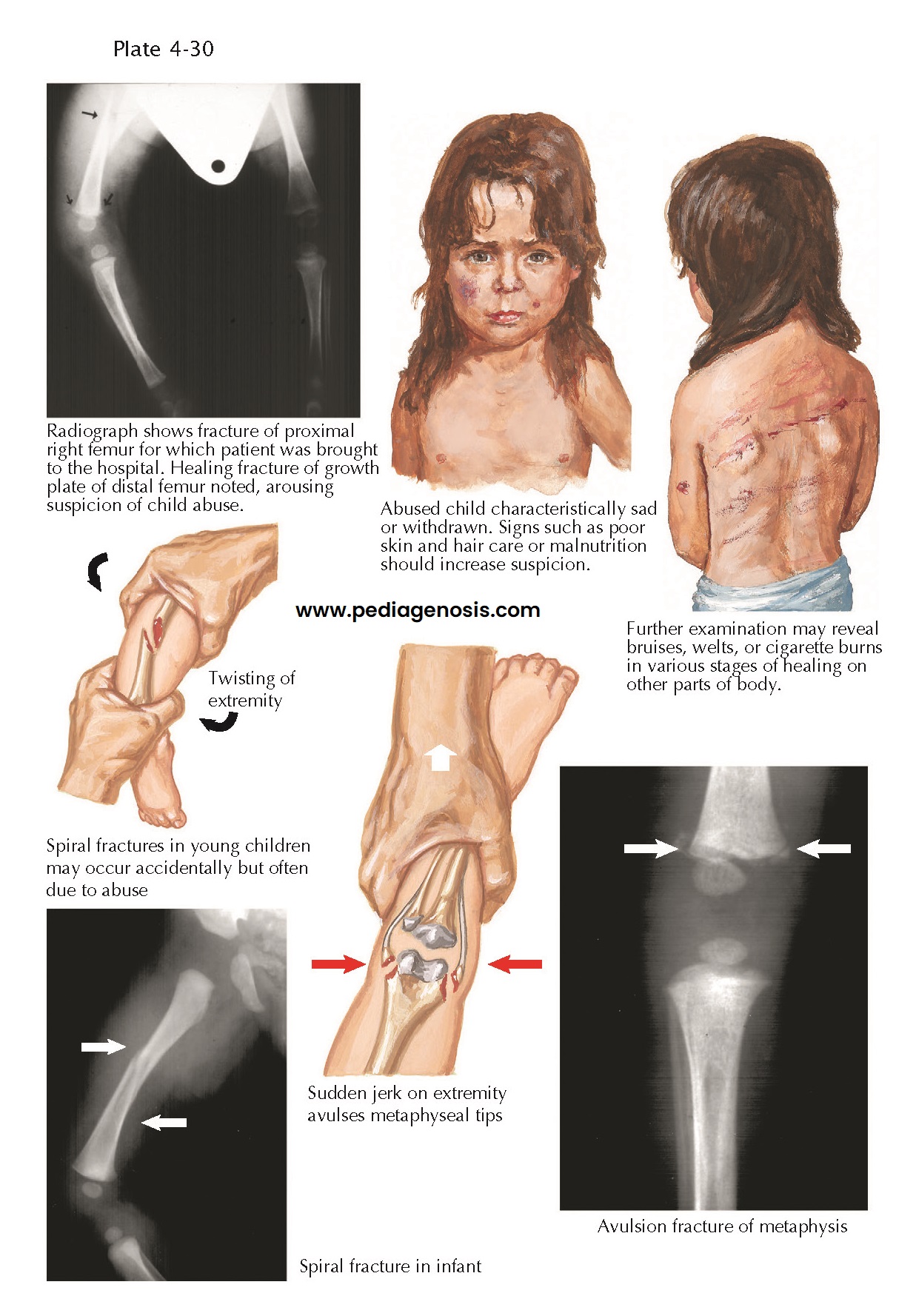 FRACTURES IN ABUSED CHILDREN