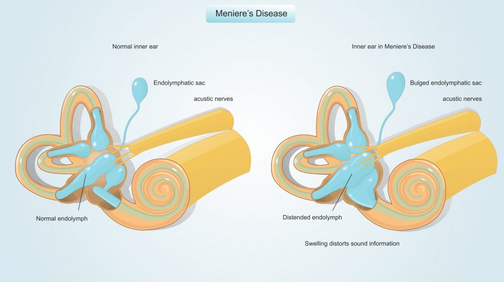 Meniere Disease