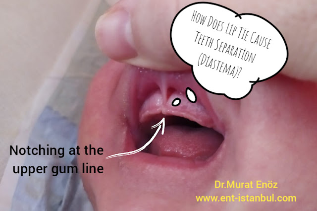 How Does Lip Tie Cause Teeth Separation (Diastema)?