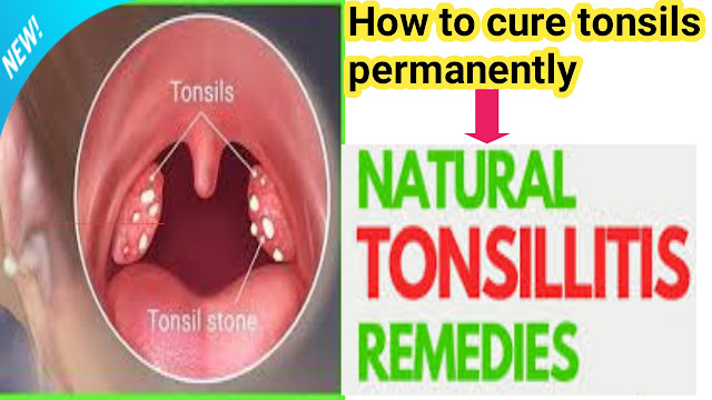 home remedies for tonsillitis,How to cure tonsillitis in 4 hours,How to cure tonsils fast,Swollen tonsils,Tonsillitis food to avoid,How to cure tonsils permanently, Treatment for tonsillitis in child,Best Medicine for tonsillitis,Foods to cure tonsillitis