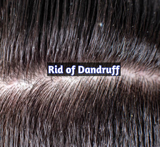 How to get rid of dandruff in winter result in 1 wash
