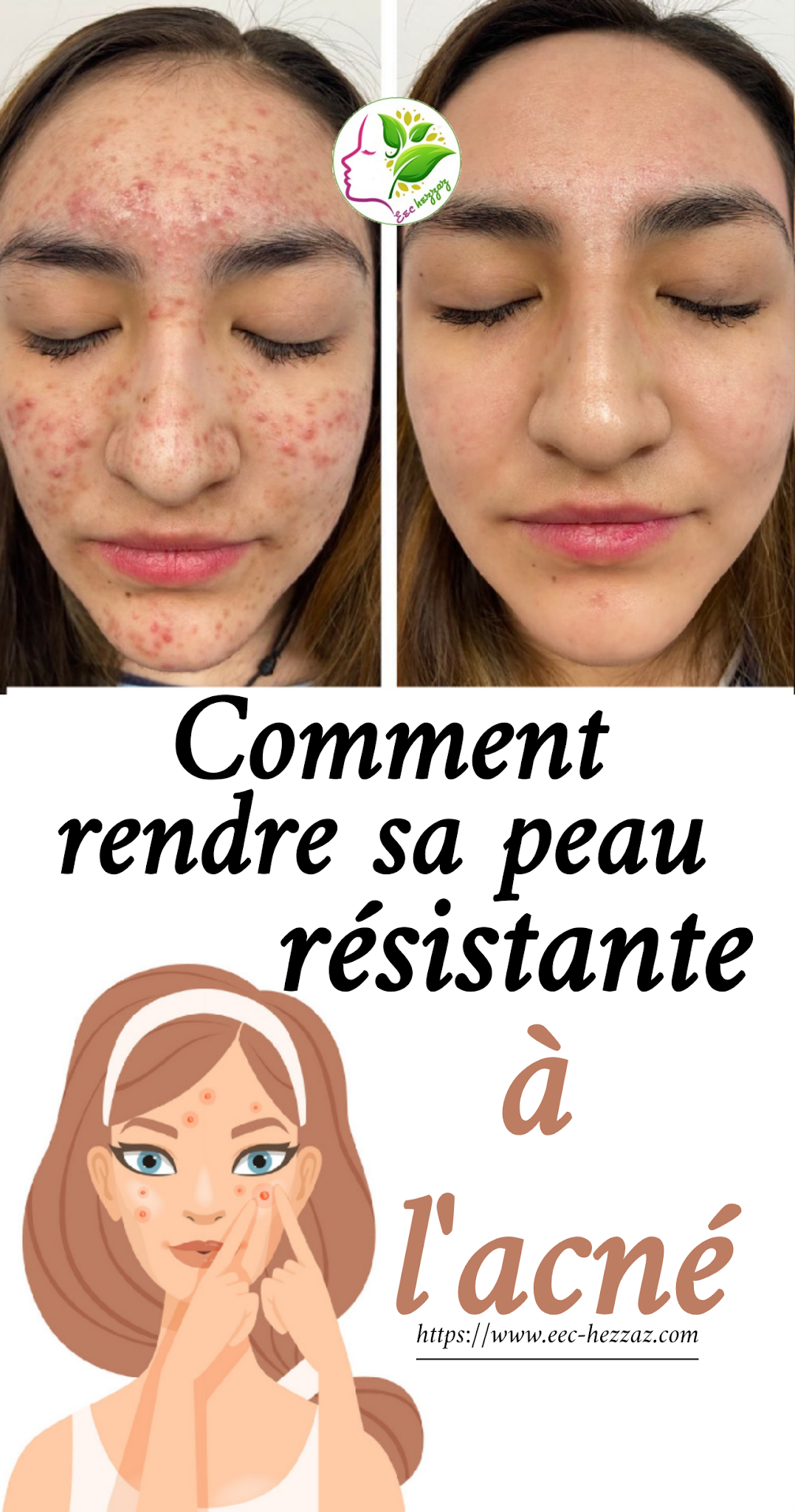 Comment rendre sa peau résistante à l'acné
