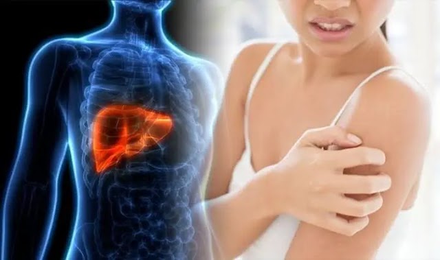 2 Signs Of Liver Cancer That May Be Noticeable On The Skin - Gloracegistmedia