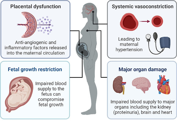 Preeclampsia Diagnostics