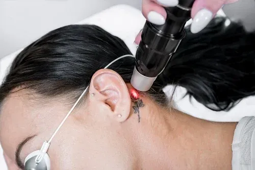 laser away tattoo removal