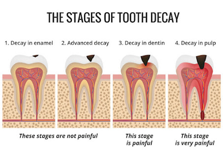 Early Stages of tooth decay