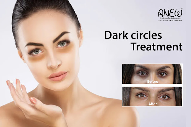 Dark Circle treatment In Banglore