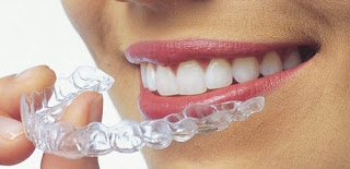 GIá niềng răng không mắc cài 3D Clear-2