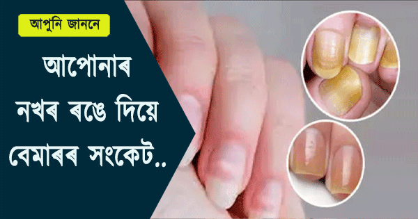 à¦à¦ªà§à¦¨à¦¾à§° à¦¨à¦à§° à§°à¦à§° à¦ªà§°à¦¾ à¦à¦® à¦ªà¦¾à¦¬ à¦à¦ªà§à¦¨à¦¾à§° à¦¬à§à¦®à¦¾à§°à§° à¦²à¦à§à¦·à¦£, à¦­à§à¦²à¦¤à§ à¦à¦à¦¨à§° à¦¨à¦à§°à¦¿à¦¬ ! Color Of Nail Indicates Health Problem