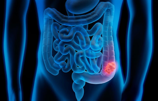 8 Early Signs of Colon Cancer You Should Know