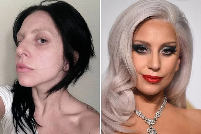 The before and after Surgeries pic of Lady Gaga!