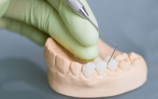 Tiêu chuẩn cơ sở làm răng sứ cho răng hô uy tín-2