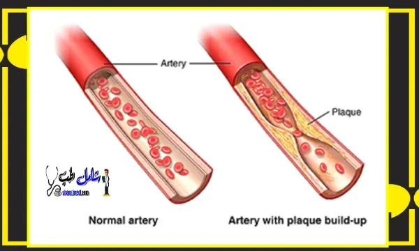 تصلب الشرايين؟ الأسباب، الأعراض، وطرق علاج تصلب الشرايين؟