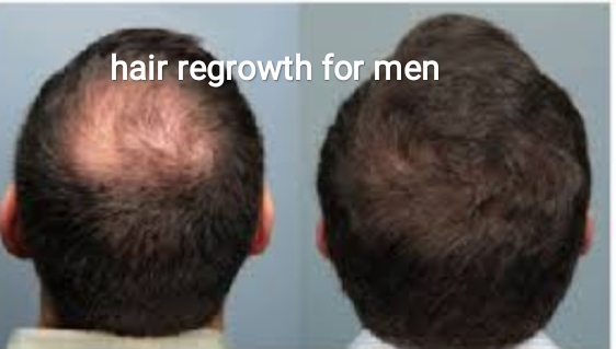 hair regrowth for men